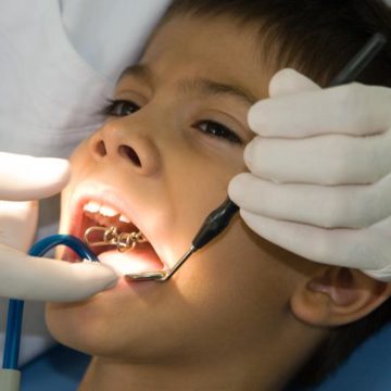Applying Braces Treatment - Tooth+Tusk Pediatric Dentistry
